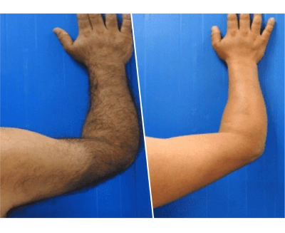 Men Before and After Skin Treatment